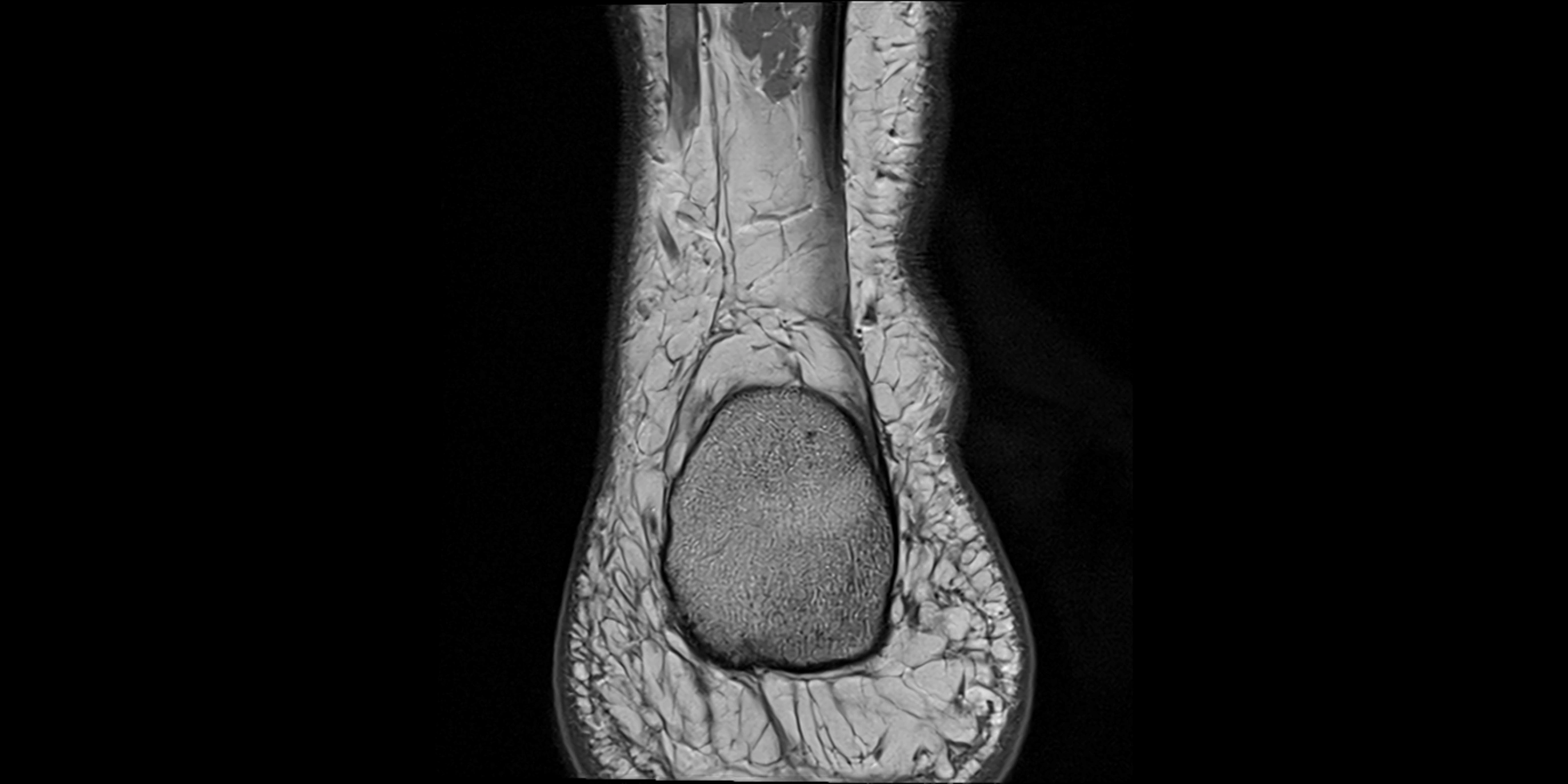 MRI Ankle coronal ligaments cross sectional anatomy 3T  radiology  image-img-00001-00029.webp